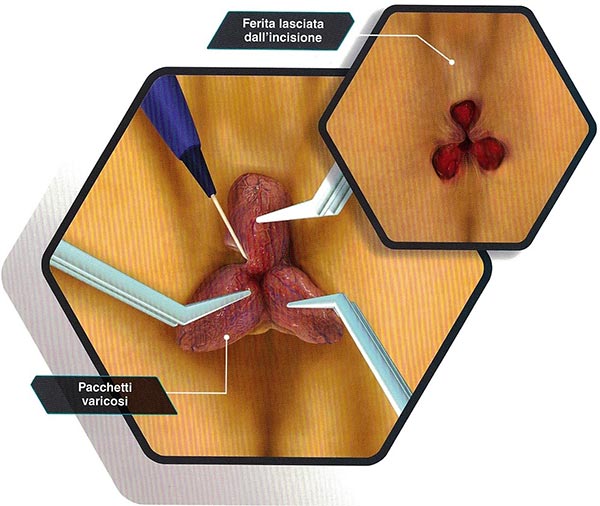 Emorroidectomia secondo Milligan Morgan